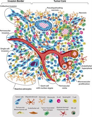 Uncovering Spatiotemporal Heterogeneity of High-Grade Gliomas: From Disease Biology to Therapeutic Implications